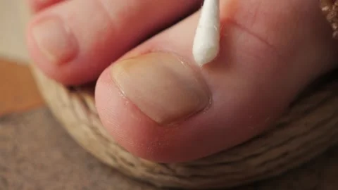 Close-up a cotton applicator gently applying antifungal treatment to a toenail. Stock Footage 336385175