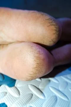 Close up of cracked on heels Stock Photos