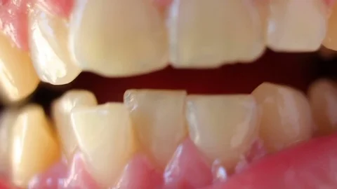 A close-up of crooked teeth Stock Footage 76714440