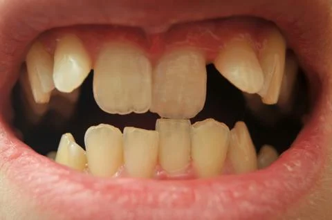 Close up of crooked teeth Stock Photos