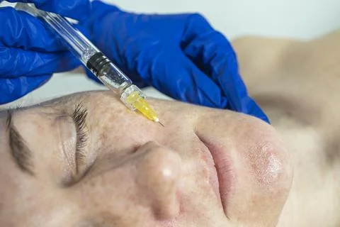 Close-up of a cropped image of a doctor's hands doing facial mesotherapy on a Stock Photos
