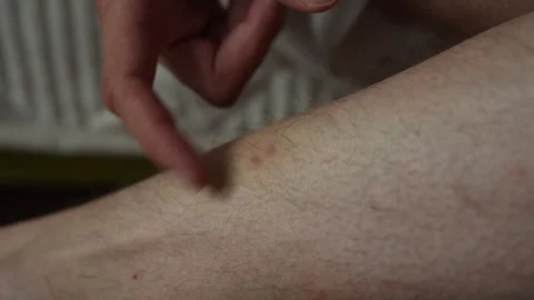 Close-up cropped shot of unrecognizable man pointing at insect bite on leg. Skin Stock Footage 342756782