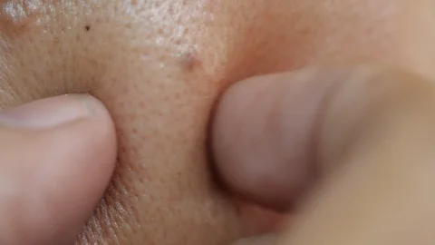 Close-up of crushes and scratches on face Stock-Footage 113596366