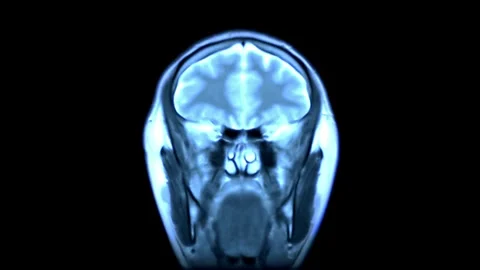 Close up of CT scan of brain anatomy health science hospital medical medicine Stock Footage 336561086