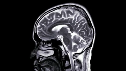Close up of CT scan of brain anatomy health science hospital medical medicine Stock Footage 336561225
