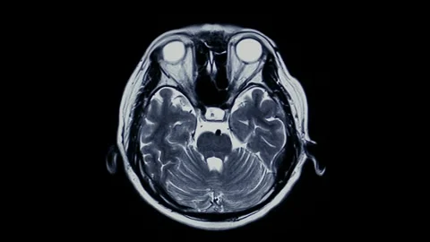 Close up of CT scan of brain anatomy health science hospital medical medicine Stock Footage 336561227