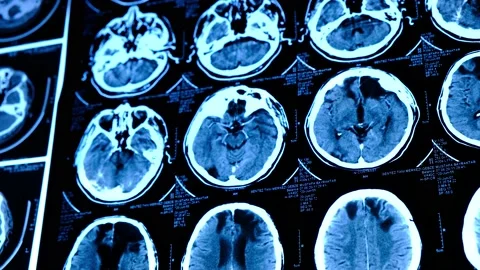 Close-up of CT scan with brain. Medicine, science and education. Stock Footage