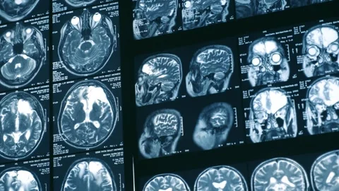 Close-up of CT scan with brain. Medicine, science and education MRI brain b.. Stock Footage 281929405