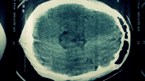Close up of CT scans of a human head from top view. Frame by frame. Video stock 145366407