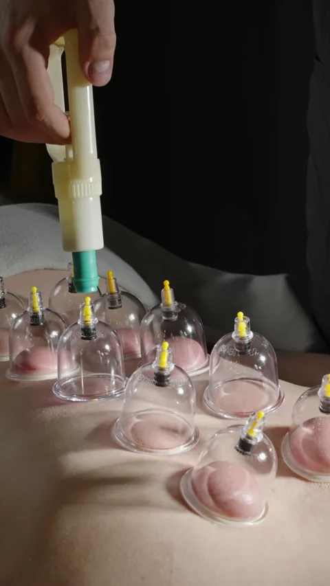 Close-up of cupping therapy session on a persons back, with multiple transparent Stock Footage 329002971