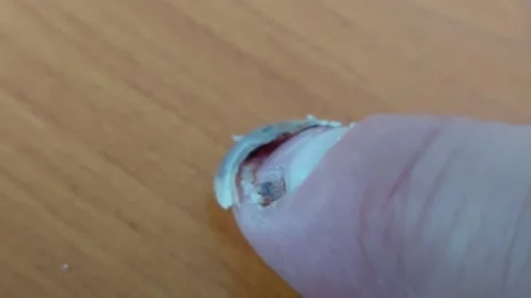 Close-up of a damaged human fingernail peeling off and separating from the nail Stock Footage 335474947