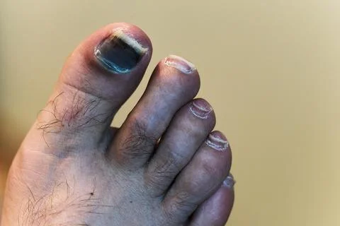 Close-up of Damaged Human Foot 스톡 사진