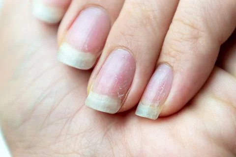Close up of damaged nails that have problem after doing manicure. Health and Fotos Stock