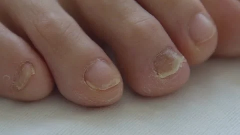 Close-up of Damaged Toenails on White Fabric, Macro Shot Stock Footage 337405264