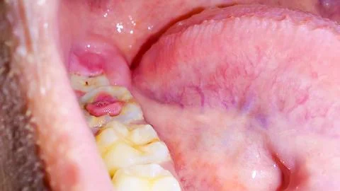 Close up of decayed molar tooth with cavity and gum growth Stock Photos