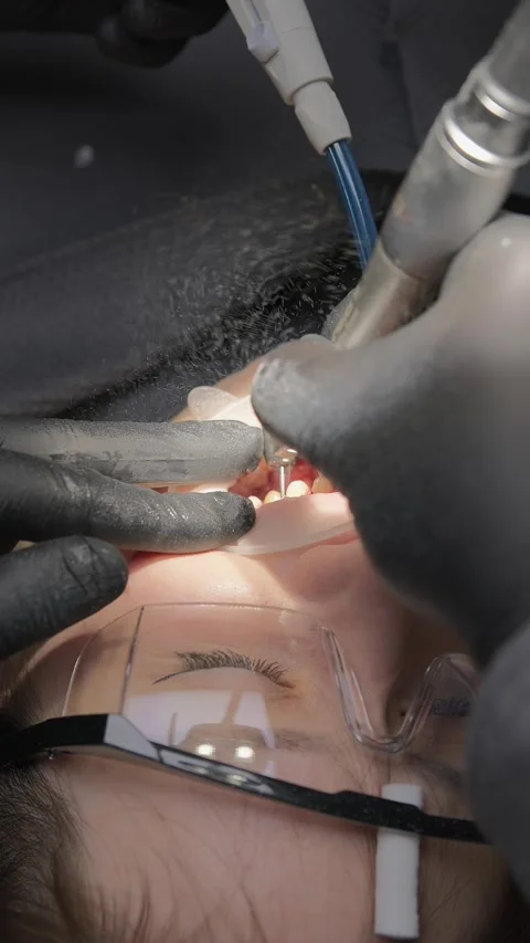 Close-up of dental drill shaping teeth for permanent crowns in young female Stock Footage 341704880