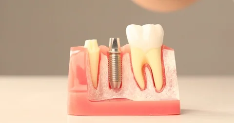 Close up of dental implant model Stock Footage 97260587