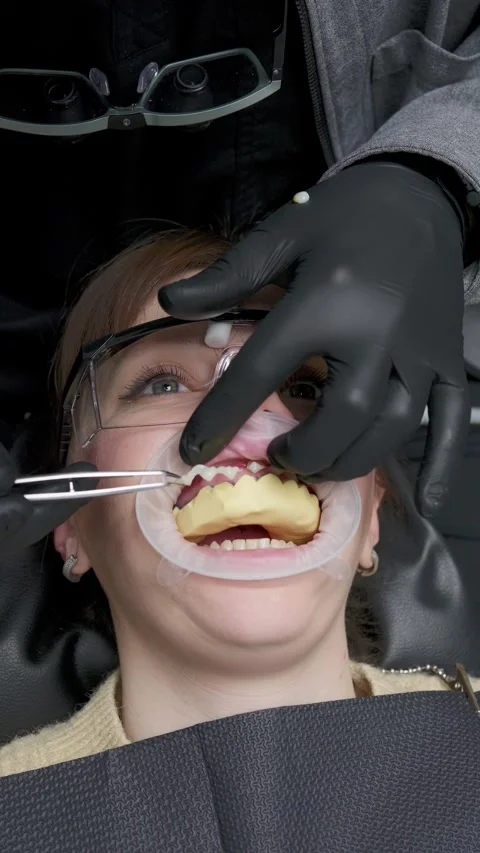 Close-up of dental impression procedure for crowns. Dentist removing excess Stock-Footage 341704868