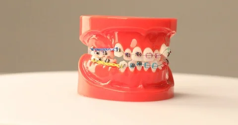 Close up of dental model with braces Stock Footage 97260830