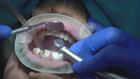 Close-up Dental Procedure Stock Footage 316914237