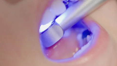 Close up dental procedure showing teeth being cleaned and polished with Stock Footage 345078312