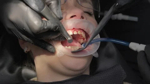 Close-up of a dental surgeon using a drill and suction tube during a Stock Footage 339274315