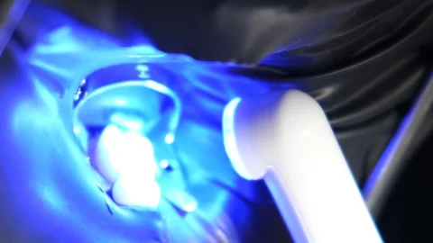 A close-up of the dental treatment process using ultraviolet light for a filling Video stock 250128438