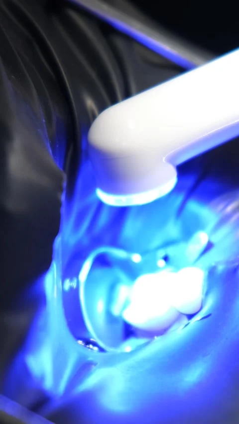 A close-up of the dental treatment process using ultraviolet light for a filling Stock-Footage 250383746