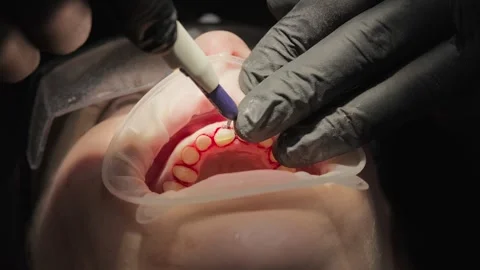 Close-up of dentist applying a light-cured gingival barrier liquid dam along the Stock Footage 339274472
