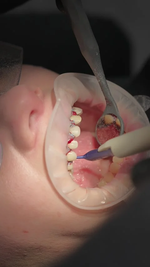 Close-up of dentist applying liquid dam along gum line before teeth whitening Stock-Footage 341704926