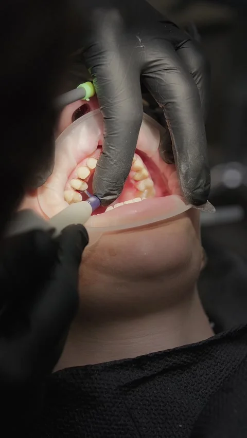 Close-up of dentist applying liquid dam on gums before teeth whitening 스톡 동영상 341704965