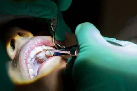 Close Up of Dentist Hand Moving a Decayed Tooth with Dental Instruments befor Stockfoto's