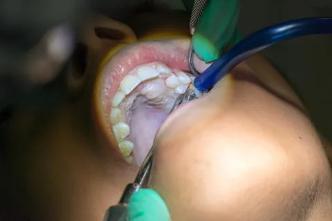 Close Up of Dentist Hand Moving a Decayed Tooth with Dental Instruments befor Stock Photos