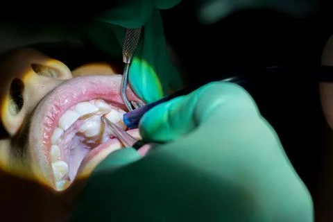 Close Up of Dentist Hand Moving a Decayed Tooth with Dental Instruments befor Stock Photos