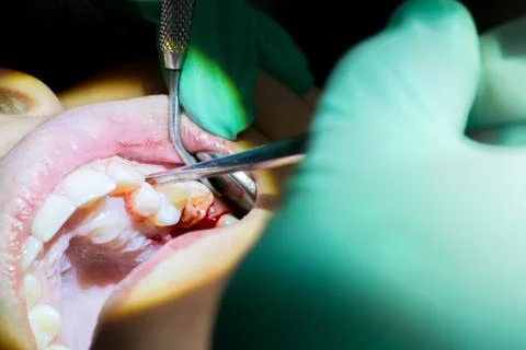 Close Up of Dentist Hand Moving a Decayed Tooth with Dental Instruments befor Stock Photos