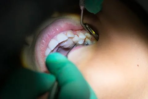 Close Up of Dentist Hand Moving a Decayed Tooth with Dental Instruments befor Stock Photos