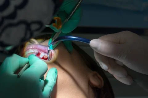 Close Up of Dentist Hands While the Inspection of Bloody Gums after the Extra Stock Photos