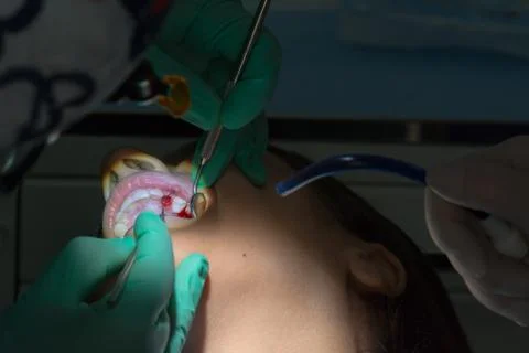 Close Up of Dentist Hands While the Inspection of Bloody Gums after the Extra Stockfoto's