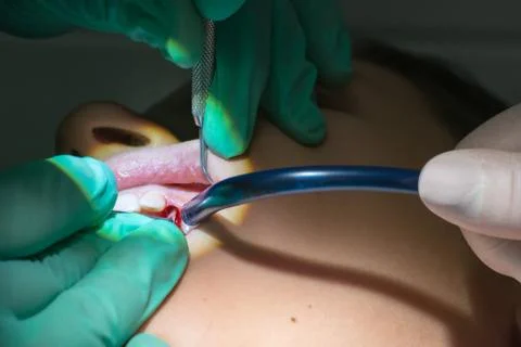 Close Up of Dentist Hands While the Inspection of Bloody Gums after the Extra Stockfoto's