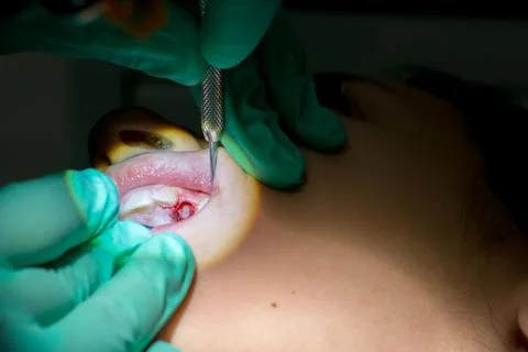 Close Up of Dentist Hands While the Inspection of Bloody Gums after the Extra Stock Photos