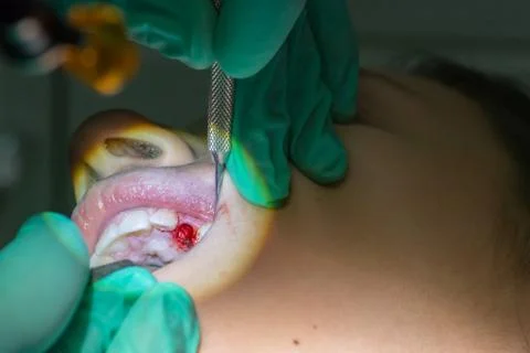 Close Up of Dentist Hands While the Inspection of Bloody Gums after the Extra Stock Photos