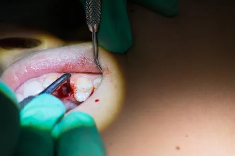 Close Up of Dentist Hands While the Inspection of Bloody Gums after the Extra Stock Photos