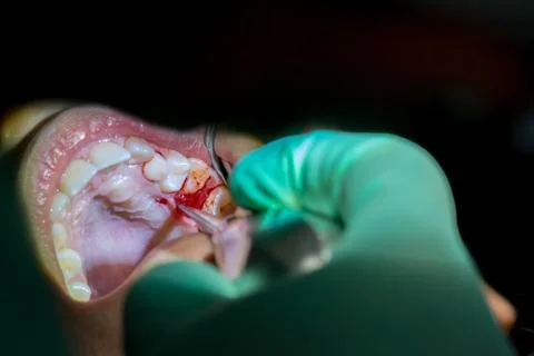 Close Up of Dentist Hands While the Inspection of Bloody Gums after the Extra 库存照片