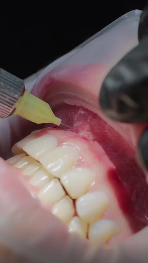 Close-up of dentist injecting local anesthesia into gum before dental treatment Stock Footage 341704860
