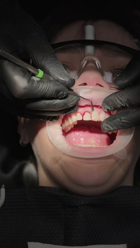 Close-up of dentist removing temporary crowns from front teeth. Prosthetic Stock-Footage 341704862