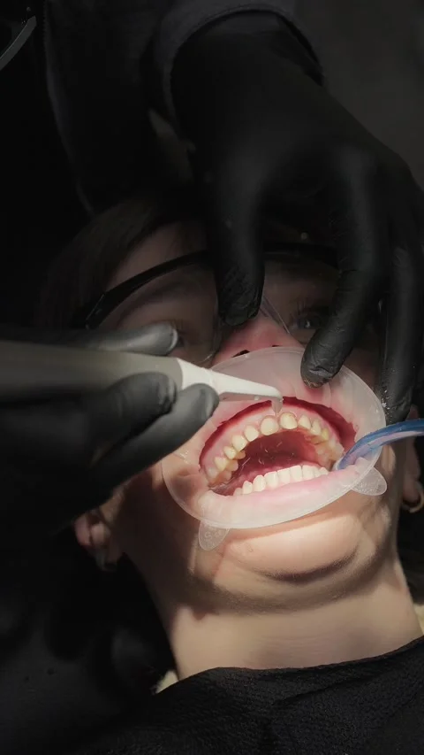 Close-up of dentist rinsing teeth and gums with water after dental procedure Video stock 341704935