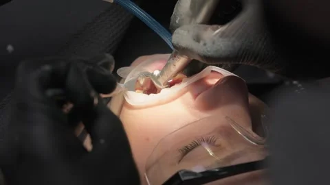 Close-up of dentist using a high-speed dental handpiece to shape teeth for crown Stock Footage 339274280