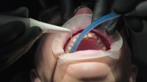 Close-up of dentist using ultrasonic scaler and suction for teeth cleaning Stock Footage 339274501