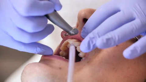 Close on Dentist Working on Patient's Teeth Video stock 168368191