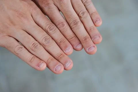 Close up detail of two hands with bitten and ugly nails Stock-Fotos